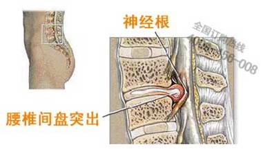 腰椎间盘突出症治疗新技术:微创腔镜下纤维环修复术